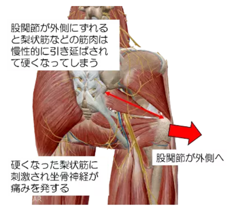 坐骨員神経痛