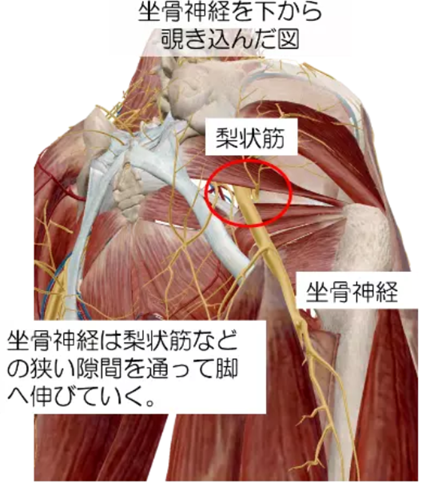 梨状筋症候群