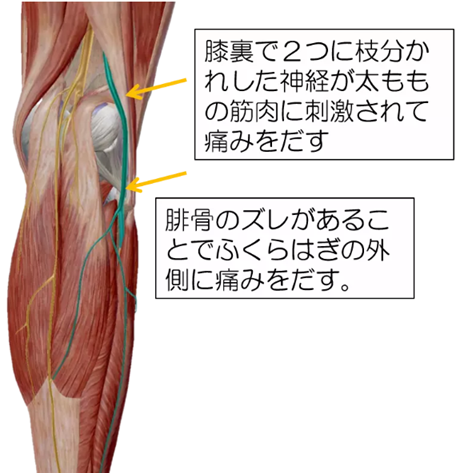 坐骨神経痛